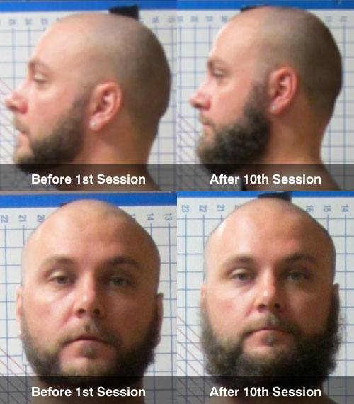 Before and after Rolfing with Jim Arkison in Ann Arbor Before and after Rolfing with Jim Arkison in Ann Arbor